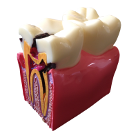 Karies-Modell gesund/Karies,1 Stk.