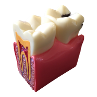 Karies-Modell gesund/Karies,1 Stk.